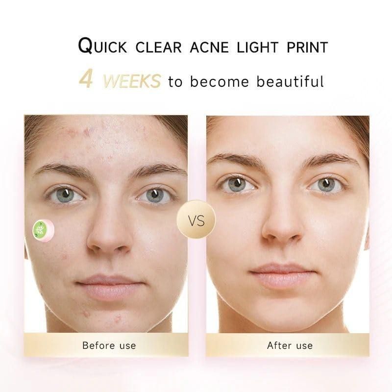Electric Acne Patches for Face Treatment, White
